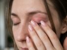 A coceira aparece nas pálpebras, mas a causa pode estar nas unhas: dermatologistas explicam como esmaltes e unhas artificiais podem provocar uma reação longe das mãos