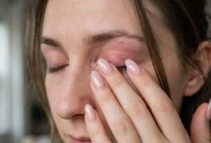A coceira aparece nas pálpebras, mas a causa pode estar nas unhas: dermatologistas explicam como esmaltes e unhas artificiais podem provocar uma reação longe das mãos