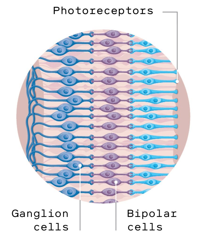 This implant can restore sight for patients with macular degeneration